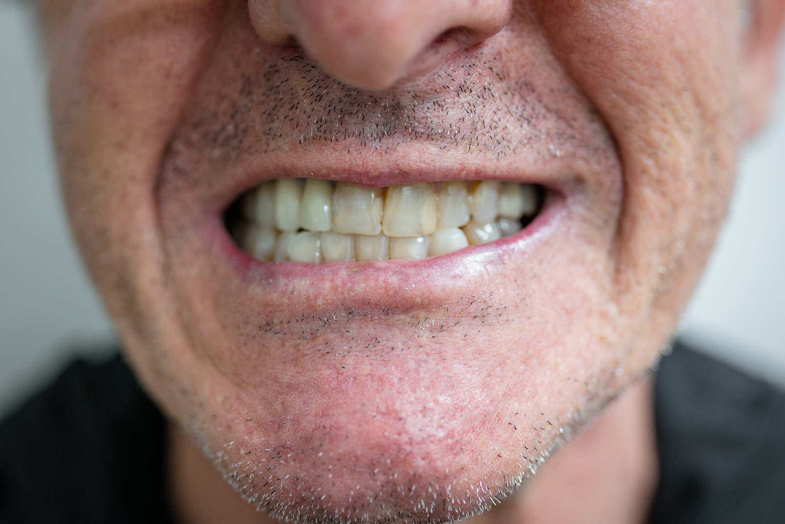 Antes - caso 1 de diseño de sonrisa