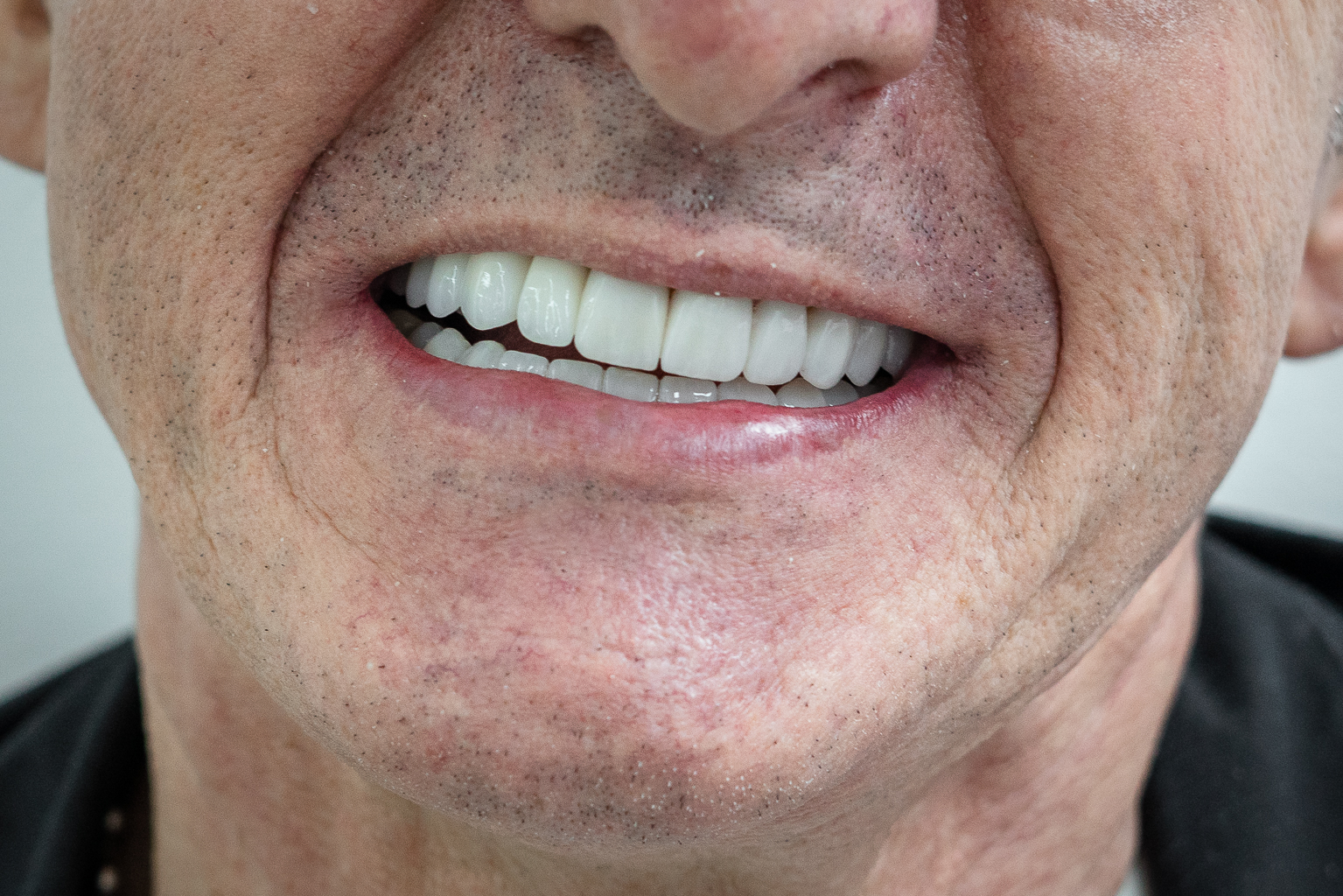 Después - caso 1 de diseño de sonrisa