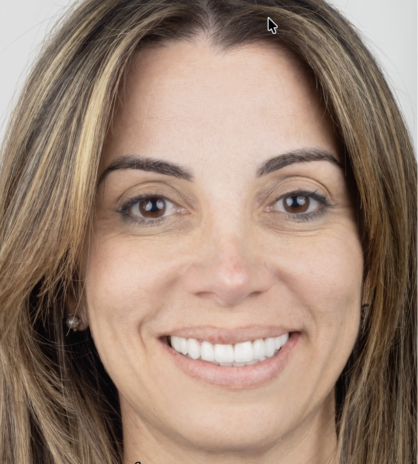 Después - caso 2 de diseño de sonrisa